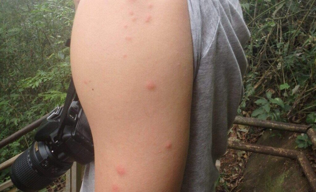 bed bug bites on a males arm